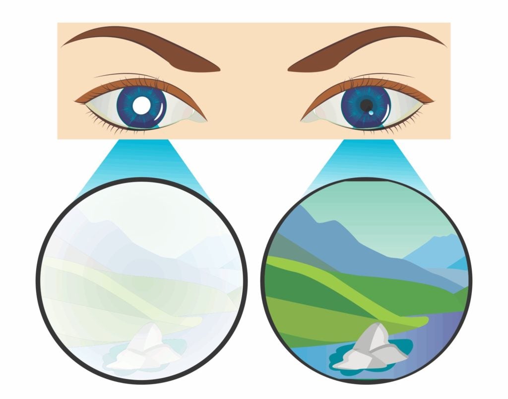 Types of Amblyopia (Lazy Eye) 3 lazy eye diagram