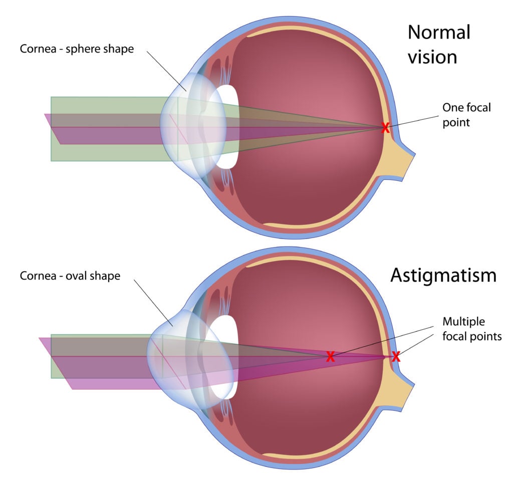 What Is Astigmatism? 3 astigmatism eye defect