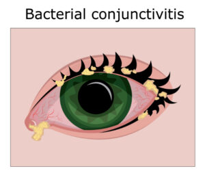 What Are Antibacterial (Antibiotic) Eye Drops? 7 Bacterial conjunctivitis