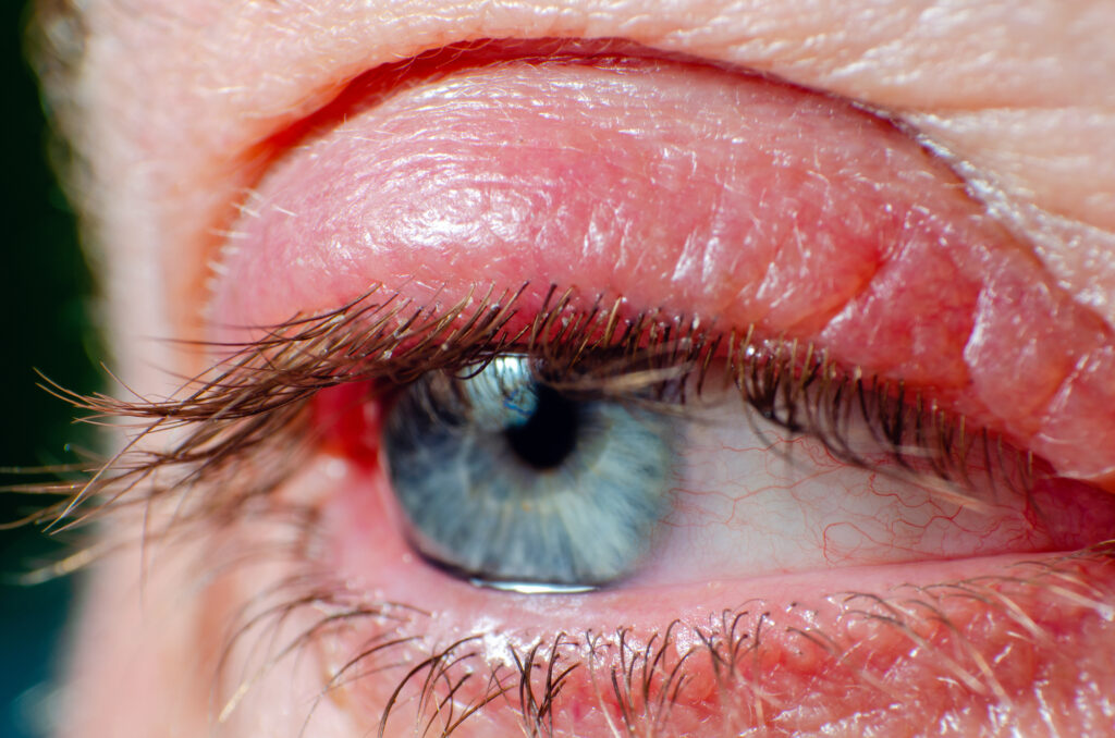 Eye Irritation 3 Blepharitis 1