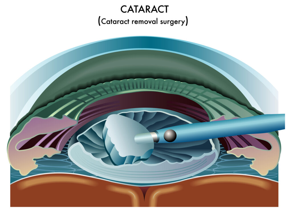 Cataracts: Symptoms, Causes, Diagnosis & Treatment 8 Cataract Surgery