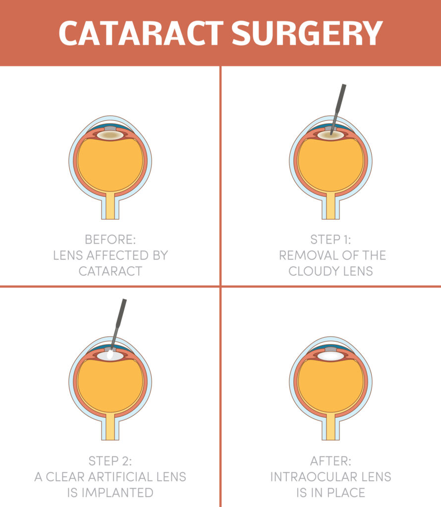 Cataract Surgery Aftercare: What to Expect and Tips for Recovery 3 Cataract surgery procedure infographic