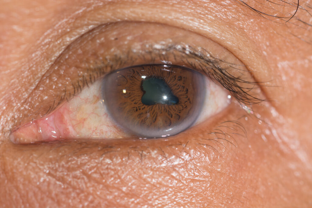Cataracts: Symptoms, Causes, Diagnosis & Treatment 9 Cataract 1