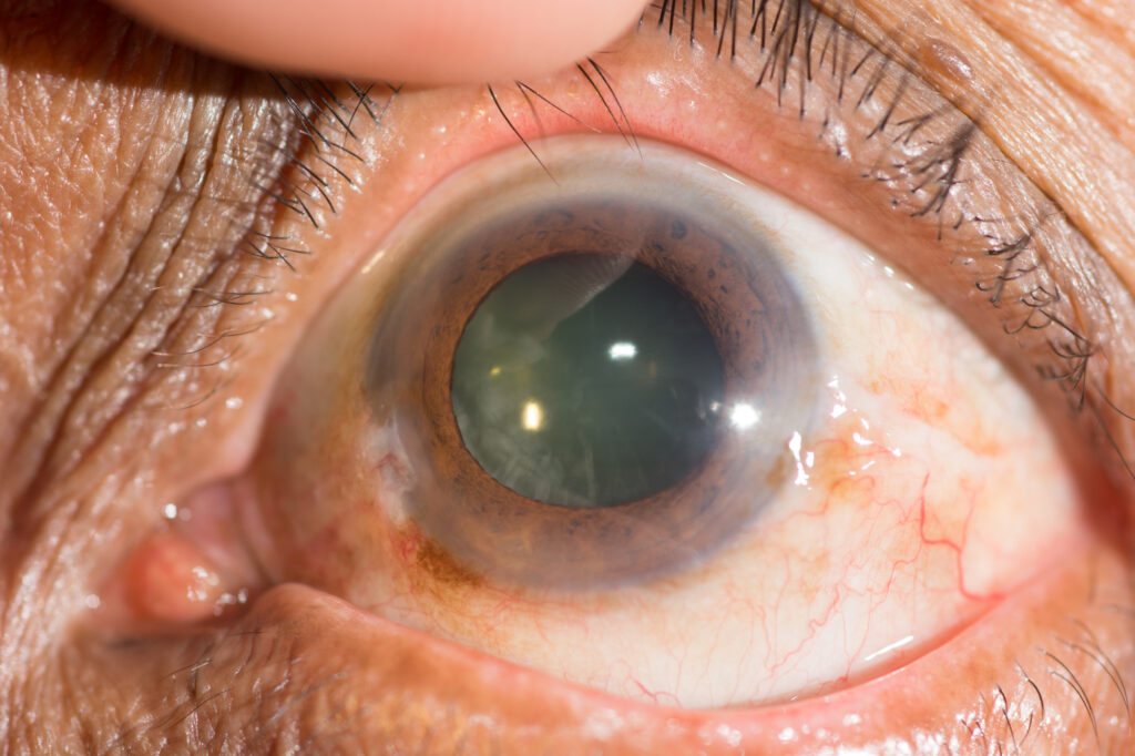 Cataracts: Symptoms, Causes, Diagnosis & Treatment 10 Cataract 2