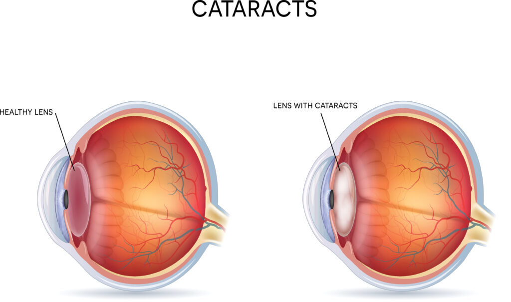 How Aging Can Change Your Vision 7 cataracts