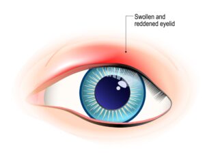 What Are Antibacterial (Antibiotic) Eye Drops? 9 Chalazion
