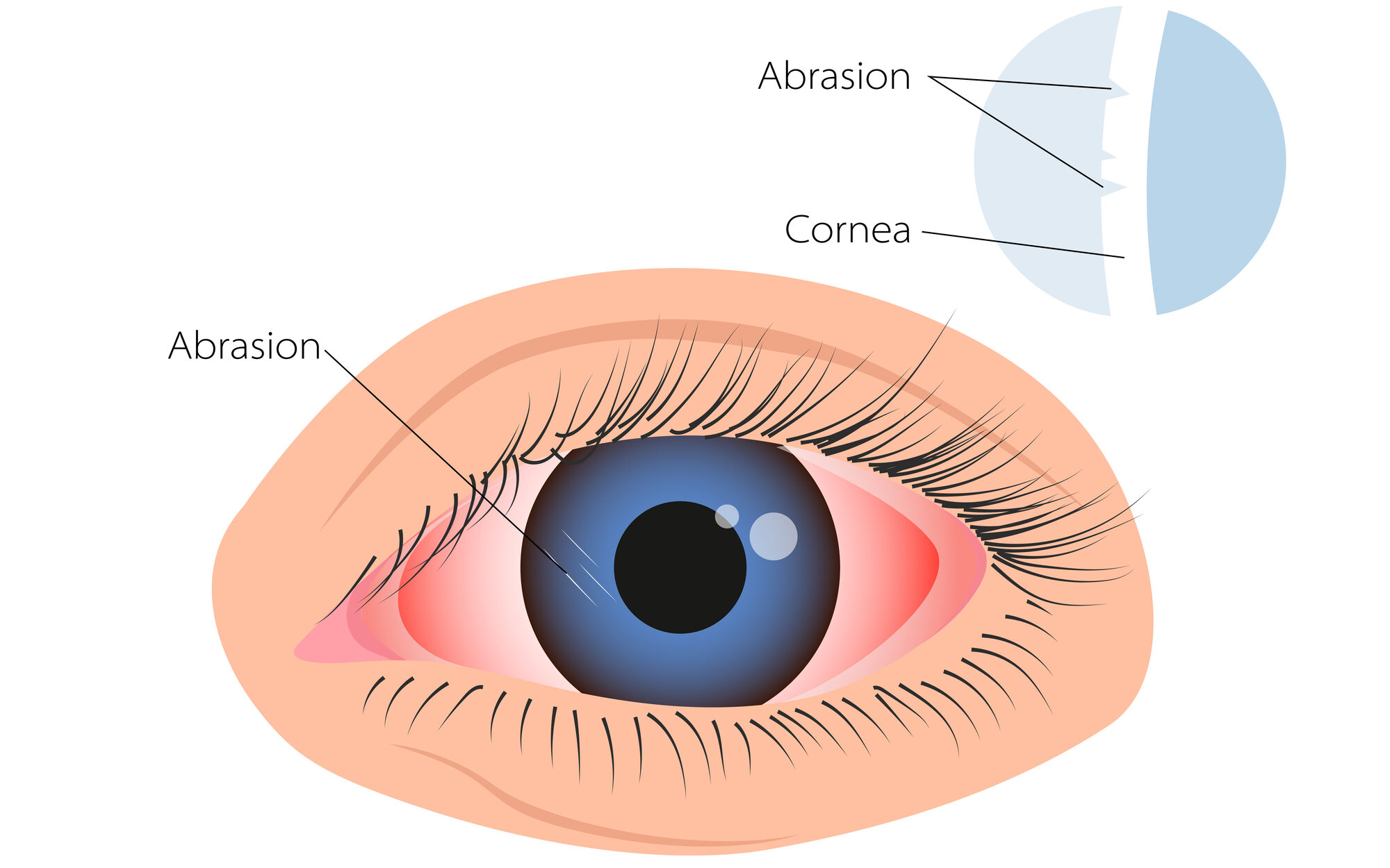 What Causes Eye Pain? Is It Dangerous? 10 Corneal Abrasion illustration edited