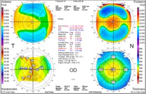 corneal topography