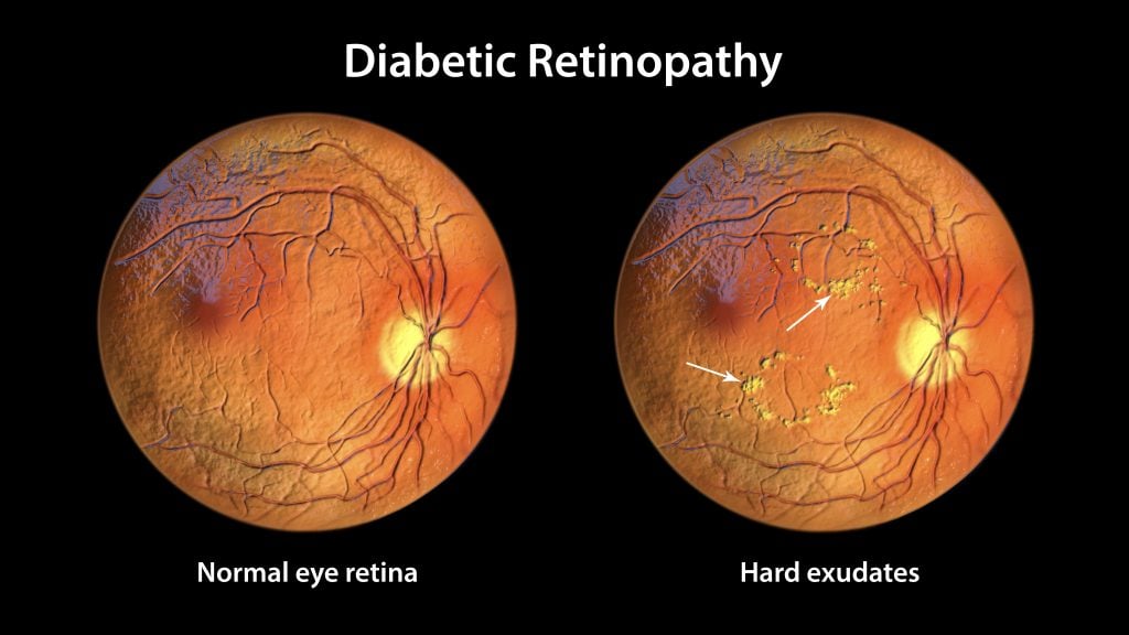 What Is a Diabetic Eye Exam? 3 Depositphotos 567244026 XL