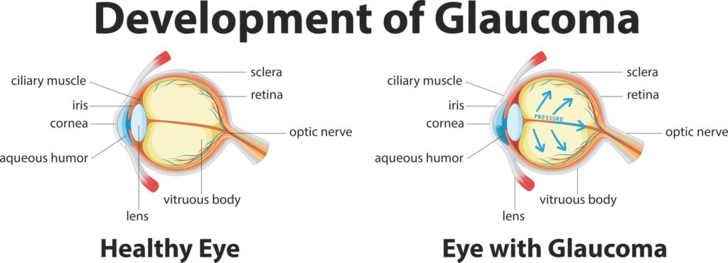 Glaucoma: Types, Symptoms, Causes, and Treatment 6 graphic showing the development of glaucoma