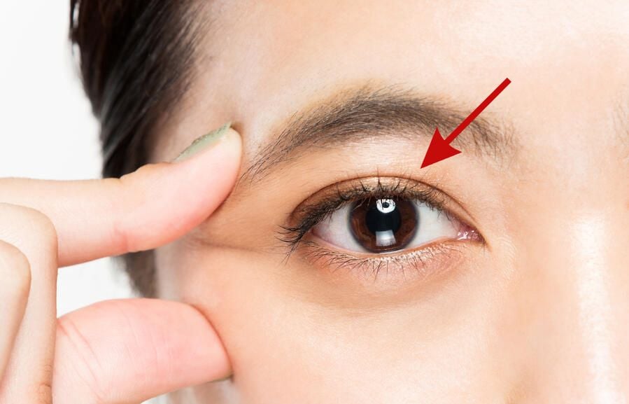 Everything You Need to Know About Double Eyelids 2 Double Eyelid 1