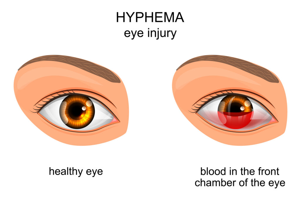 What Causes Eye Pain? Is It Dangerous? 11 Eye Injury