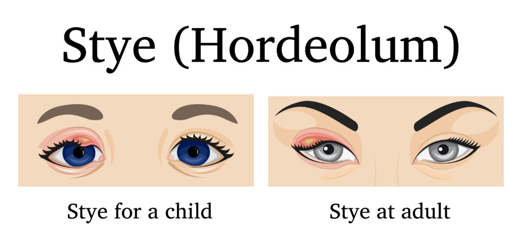 What Causes Eye Pain? Is It Dangerous? 13 Illustration of Stye