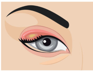 What Are Antibacterial (Antibiotic) Eye Drops? 8 eye stye