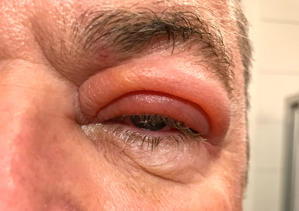 What Causes Swollen Eyelids? 4 Eyelid Swelling