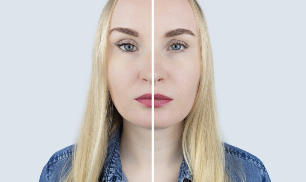 What to Know About Blepharoplasty (Eye Lift Surgery) 2 Eyelift surgery before and after comparison