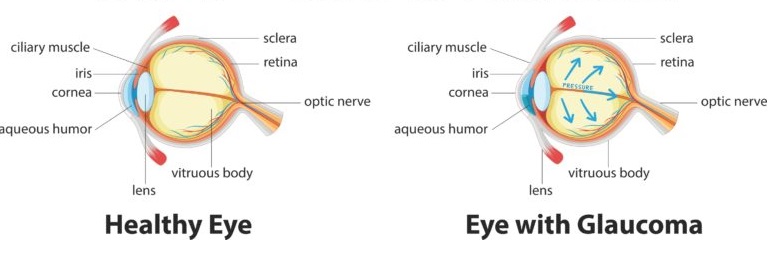 Glaucoma vs Cataracts 3 How glaucoma develops - Healthy Eye vs Eye with Glaucoma