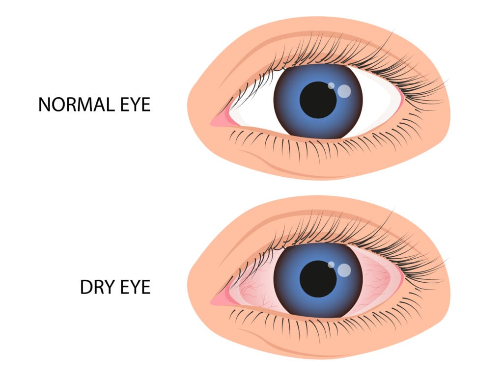 What Is Dry Eye Syndrome? 2 Human eye healthy and dry. Symptoms of keratitis allergy conjunctivitis uveitis