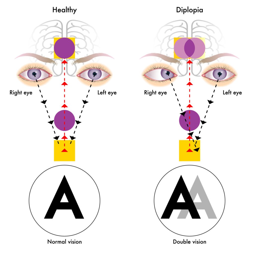 What are Prism Lenses? 4 Illustration depicting Diplopia or double vision and Healthy Eye vision comparison