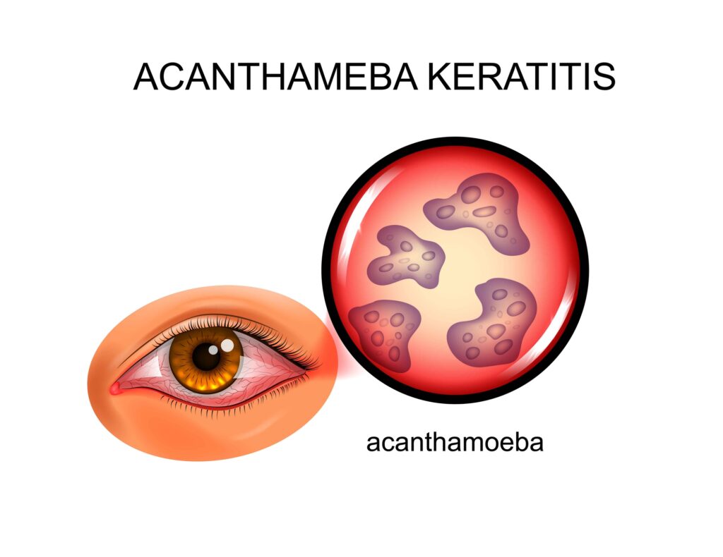 What to Know About Keratitis 3 Illustration of Parasitic keratitis or Acanthamoeba keratitis