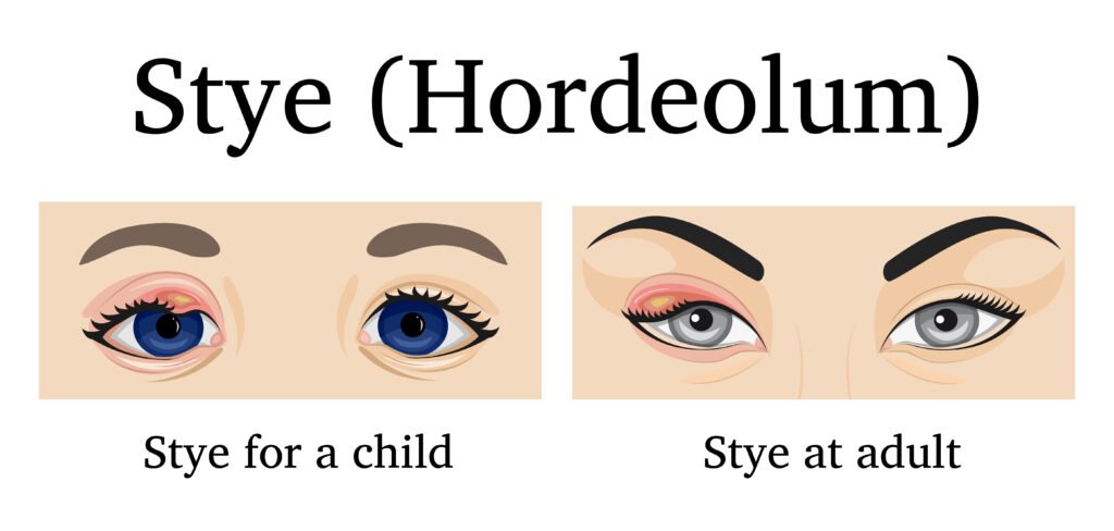 What Are Eye Styes & How Can You Get Rid of Them? 3 image 15