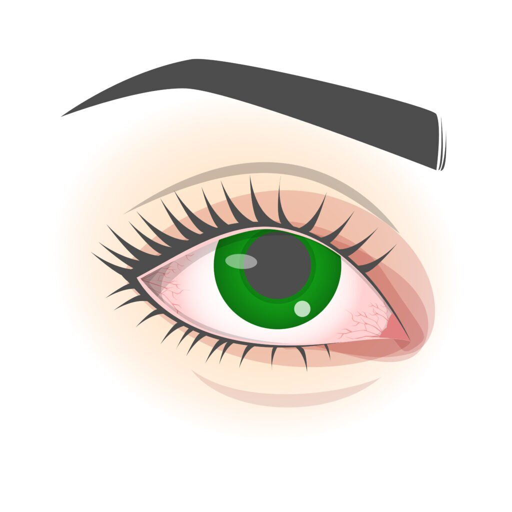 Corneal Abrasion: Understanding Scratched Cornea 4 image 17