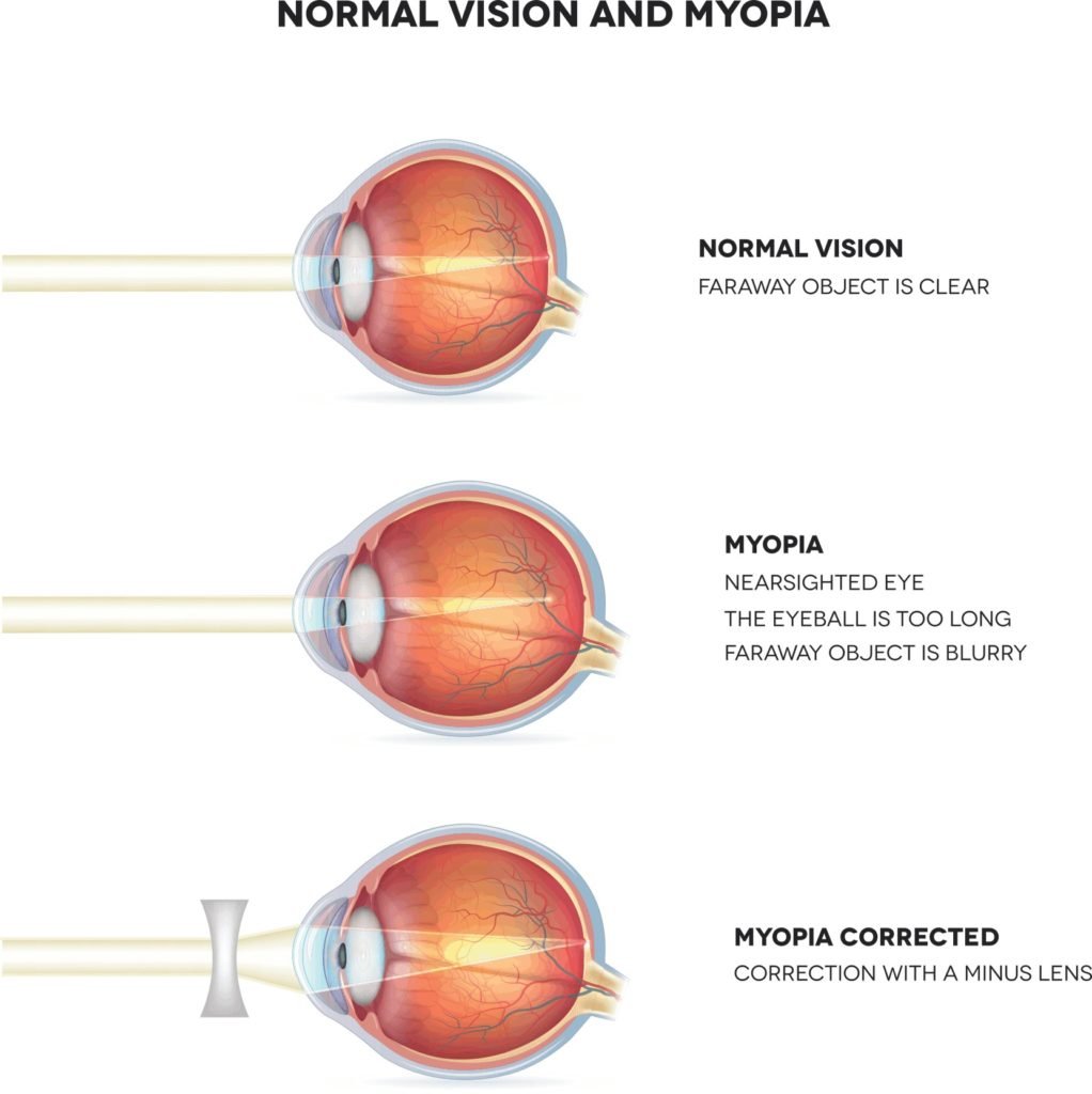 Myopia (Nearsightedness) 2 image 21