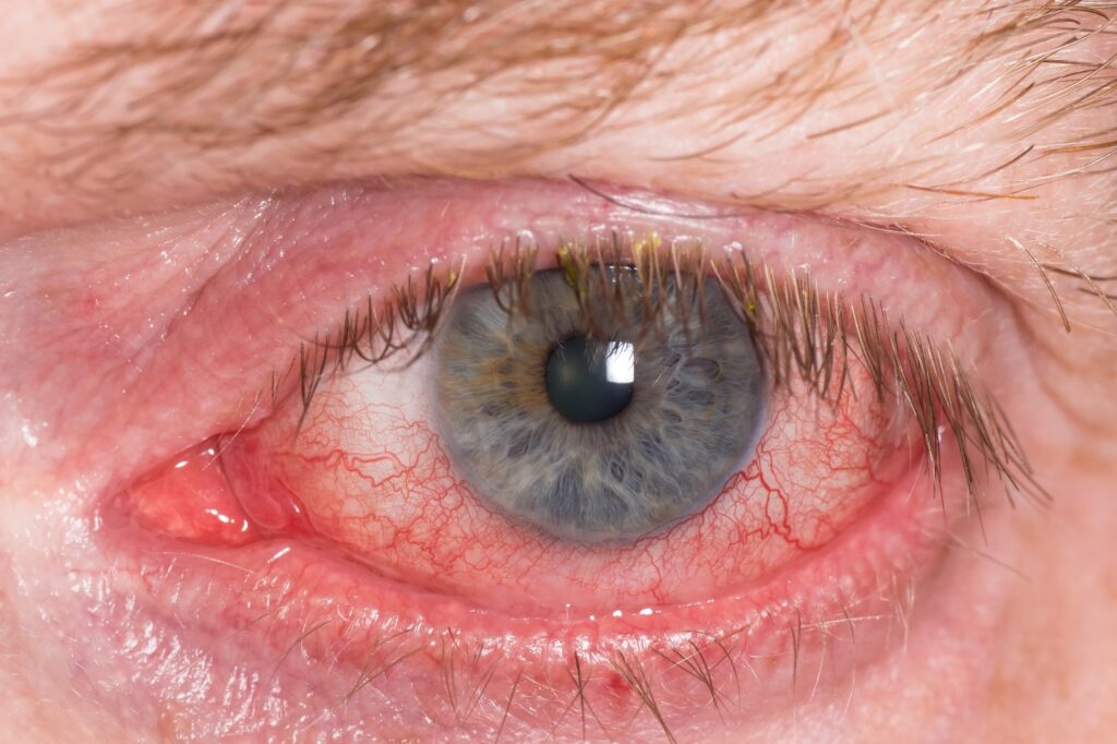 Eye Irritation 4 Irritated Eye