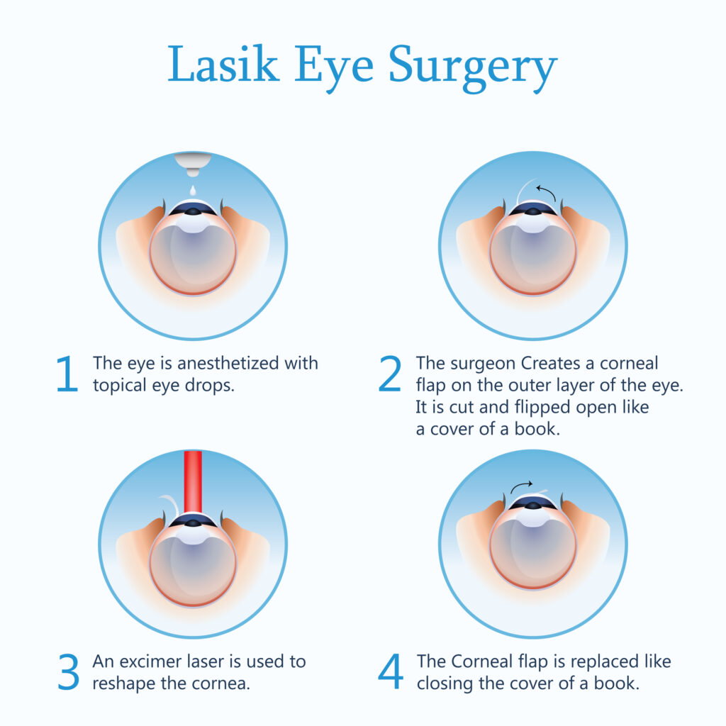 LASIK Resources 3 Laser eye surgery