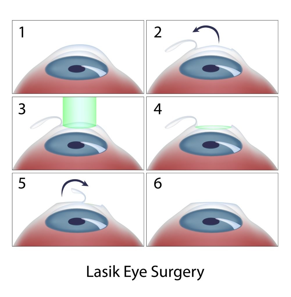 Is LASIK Safe? 2 diagram showing six steps of lasik eye surgery