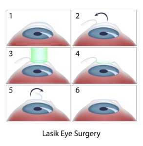 LASEK vs. LASIK: What’s the Difference? 5 lasik eye surgery steps