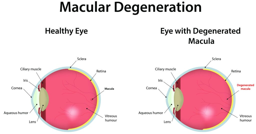 What is Age-Related Macular Degeneration? Causes, Prevention, & Treatment 5 Macular Degeneration