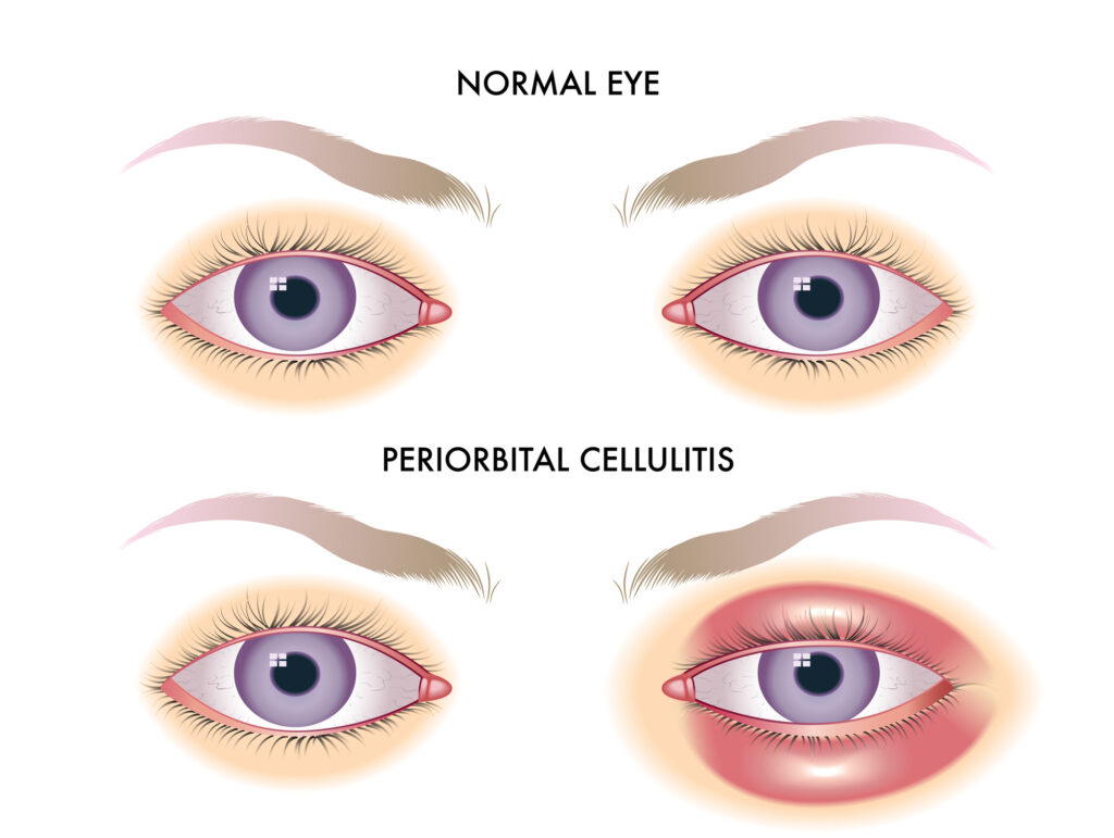 What is Periorbital Cellulitis? 2 Medical illustration showing periorbital cellulitis vs a healthy normal eye