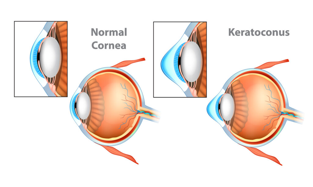 What Are Intacs? (Corneal Implants) 2 normal cornea vs Keratoconus eye