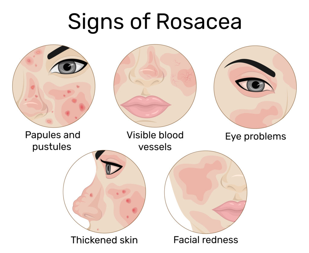 Ocular Rosacea - Symptoms, Causes, Diagnosis & Treatment 2 Ocular Rosacea symptoms