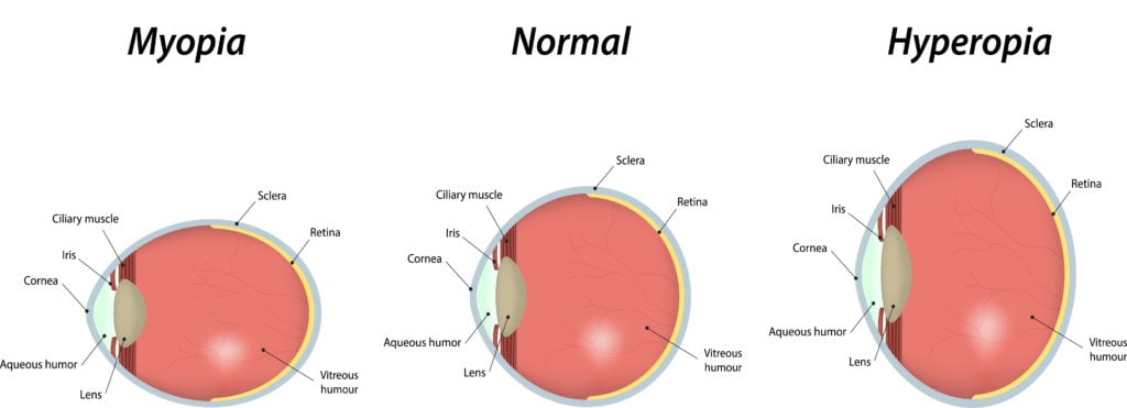 LASEK vs. LASIK: What’s the Difference? 4 graphic comparing normal vision, myopia refractive error, and hyperopia refractive error