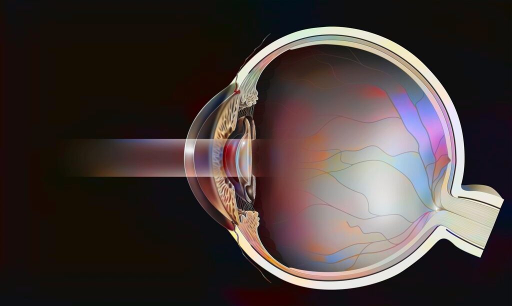 YAG Laser Capsulotomy 2 Sectional eye with secondary cataract treated with YAG laser