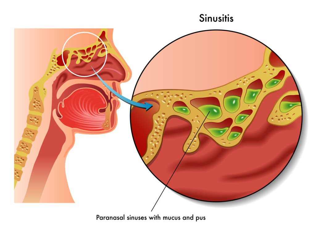 What Causes Eye Pain? Is It Dangerous? 16 Sinusitis vector