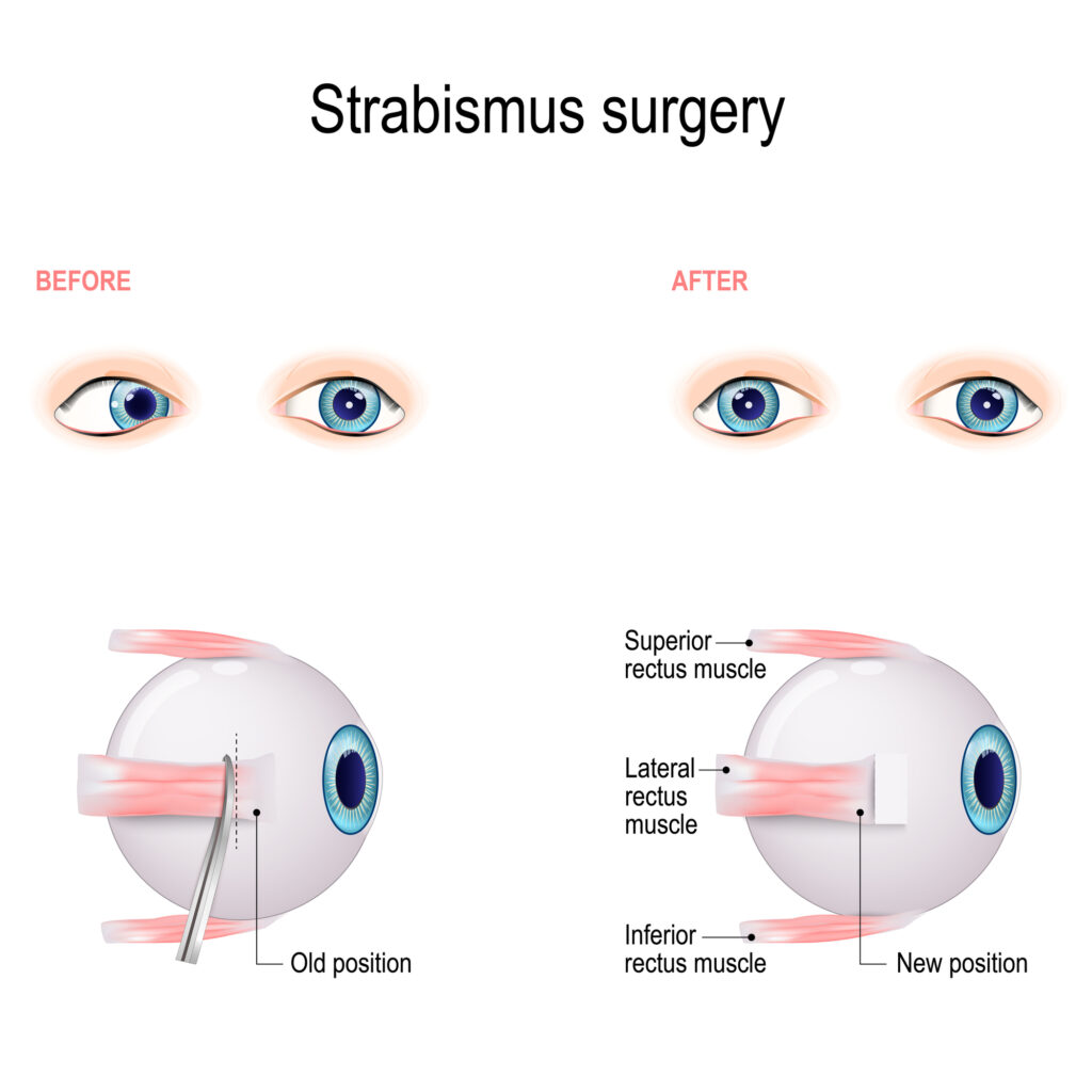 Strabismus Surgery 3 Strabismus surgery illustration