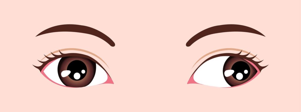 Exotropia (Outward Turning Eyes) 2 type of strabismus vector illustration exotropia