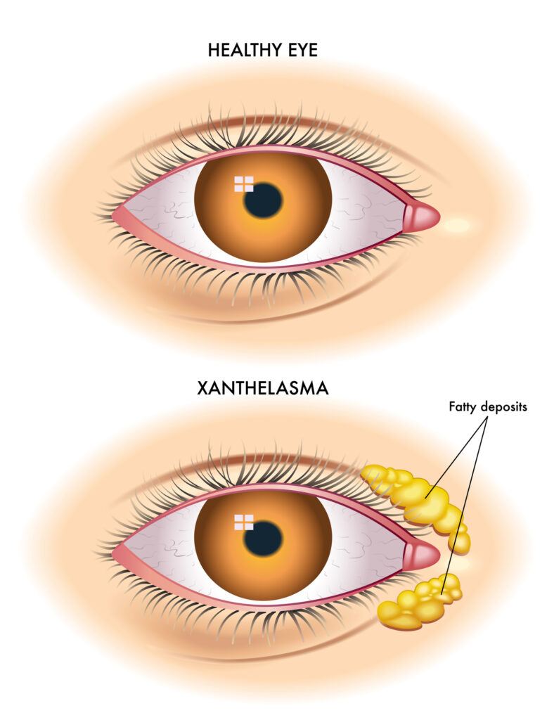 Xanthelasma 2 Vector illustration of xanthelasma versus a healthy eye