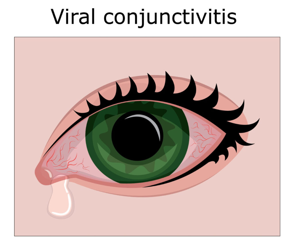 Pink Eye (Conjunctivitis) 6 viral conjunctivitis 1