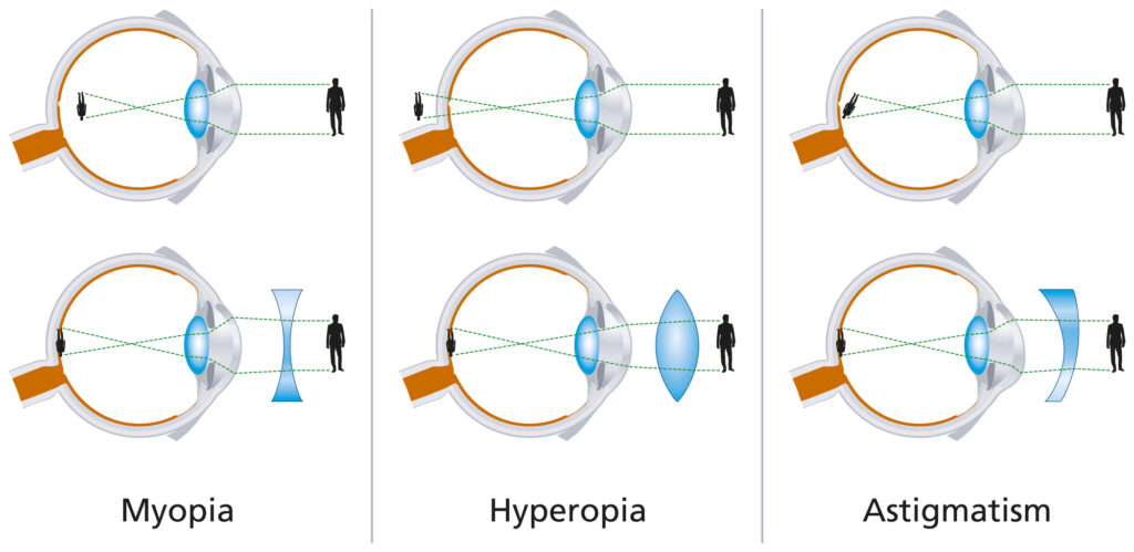 LASIK for Nearsightedness (Myopia) 3 Vision Defects Myopia Hyperopia And Astigmatism Illustrations