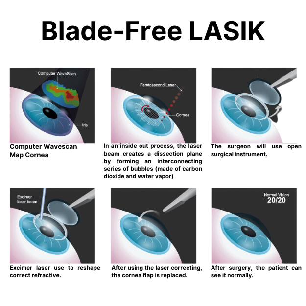 What Is iLASIK and How Does It Work? 2 Bladeless Blade Free LASIK illustration Vision Center