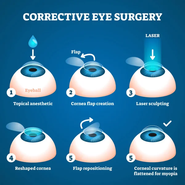 LASIK Surgery Cost 2 Corrective eye surgery