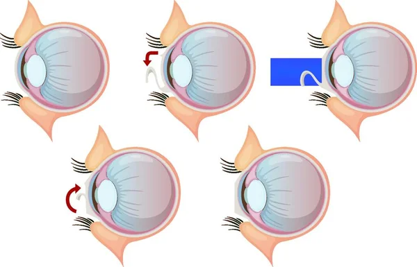 LASIK Eye Surgery - Procedure, Aftercare, Risks & Costs 3 depositphotos 622766512 stock illustration laser eye correction graphic vector