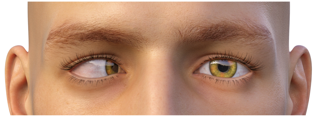 Understanding Esotropia: Types, Causes, Symptoms & Treatment 2 Esotropia illustration