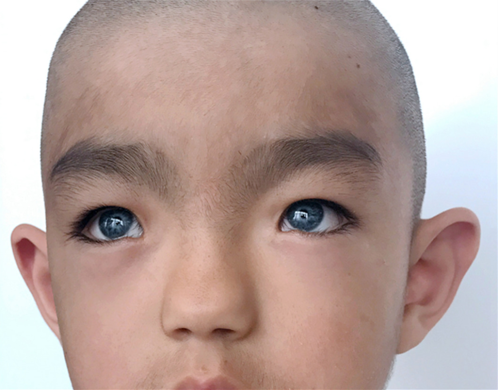 How Does Waardenburg Syndrome Affect Eye Health? 2 Facial appearance of a boy from China with Waardenburg syndrome type 1