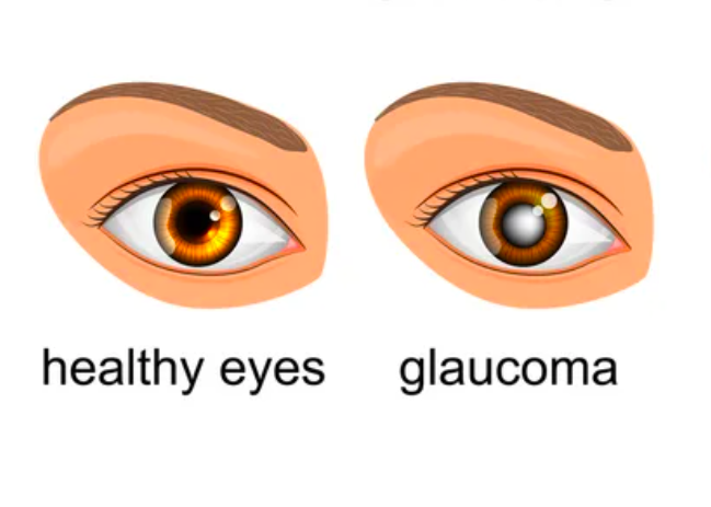 What Causes Eye Pain? Is It Dangerous? 14 Glaucoma Vector