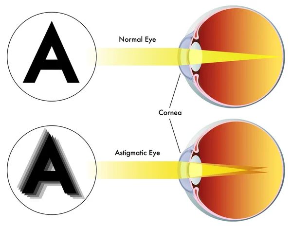 Types of Contact Lenses 4 image 1